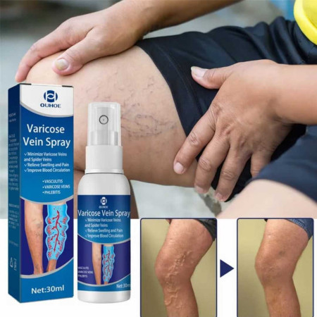 (2pcs) Varicose Veins Spray