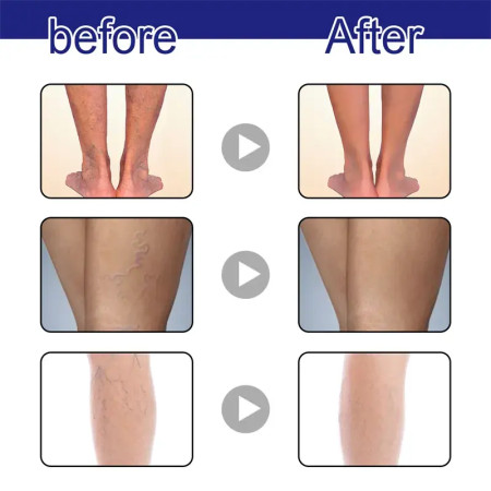(2pcs) Varicose Veins Spray